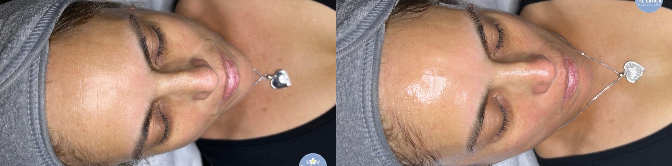 Before & After Hydrafacial™ Client #39 Front View in Tampa Bay, North Palm Beach, FL