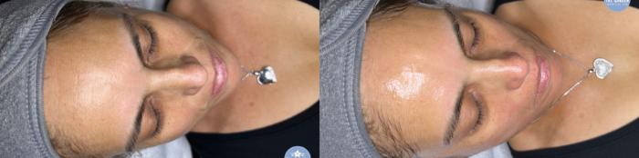 Before & After Hydrafacial™ Client #39 Front View in Tampa Bay, North Palm Beach, FL