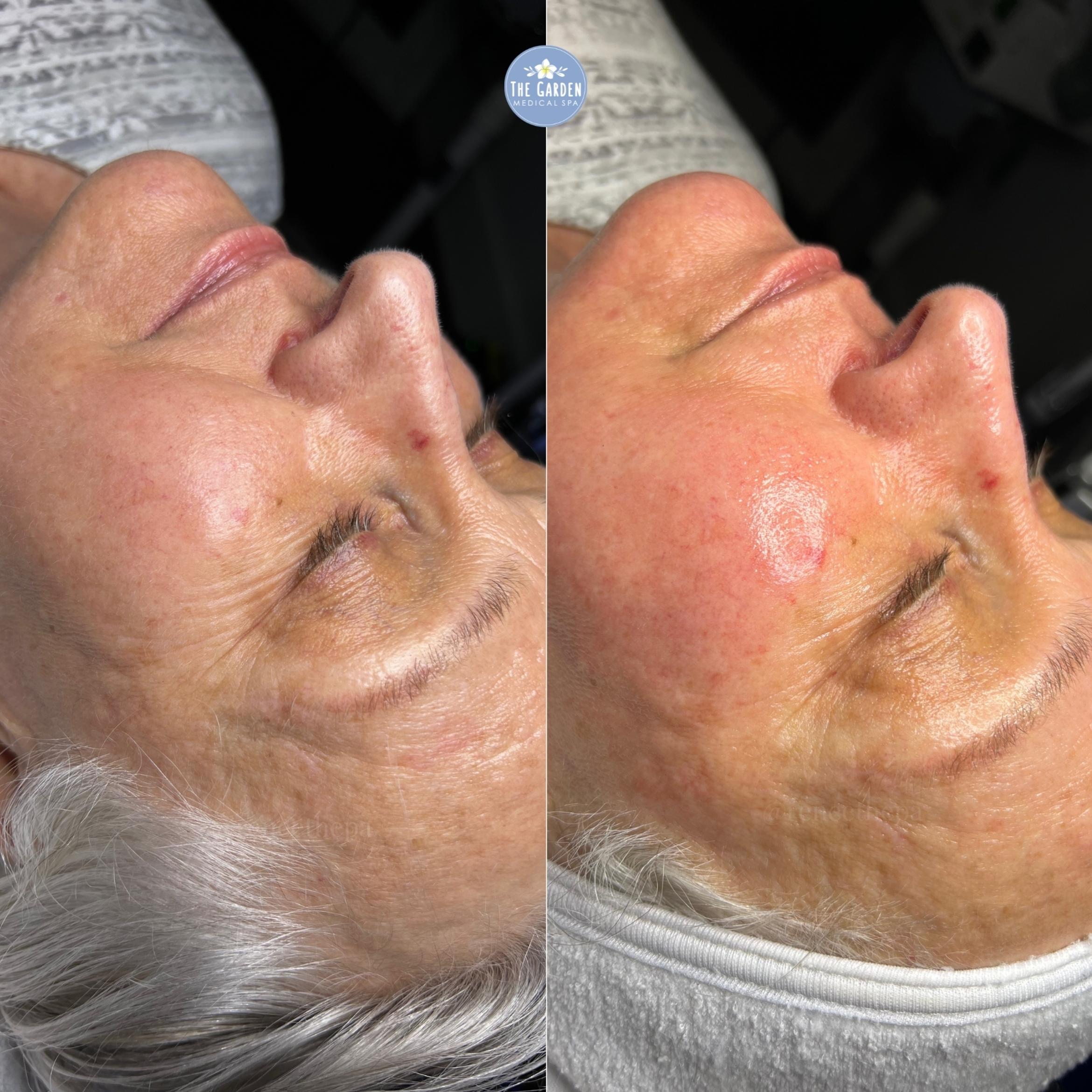 Before & After Hydrafacial™ Client #43 Left Side View in Tampa Bay, North Palm Beach, FL