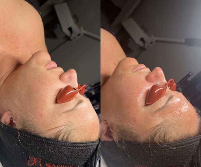 Before & After Hydrafacial™ Client #56 Left Side View in Tampa Bay, North Palm Beach, FL