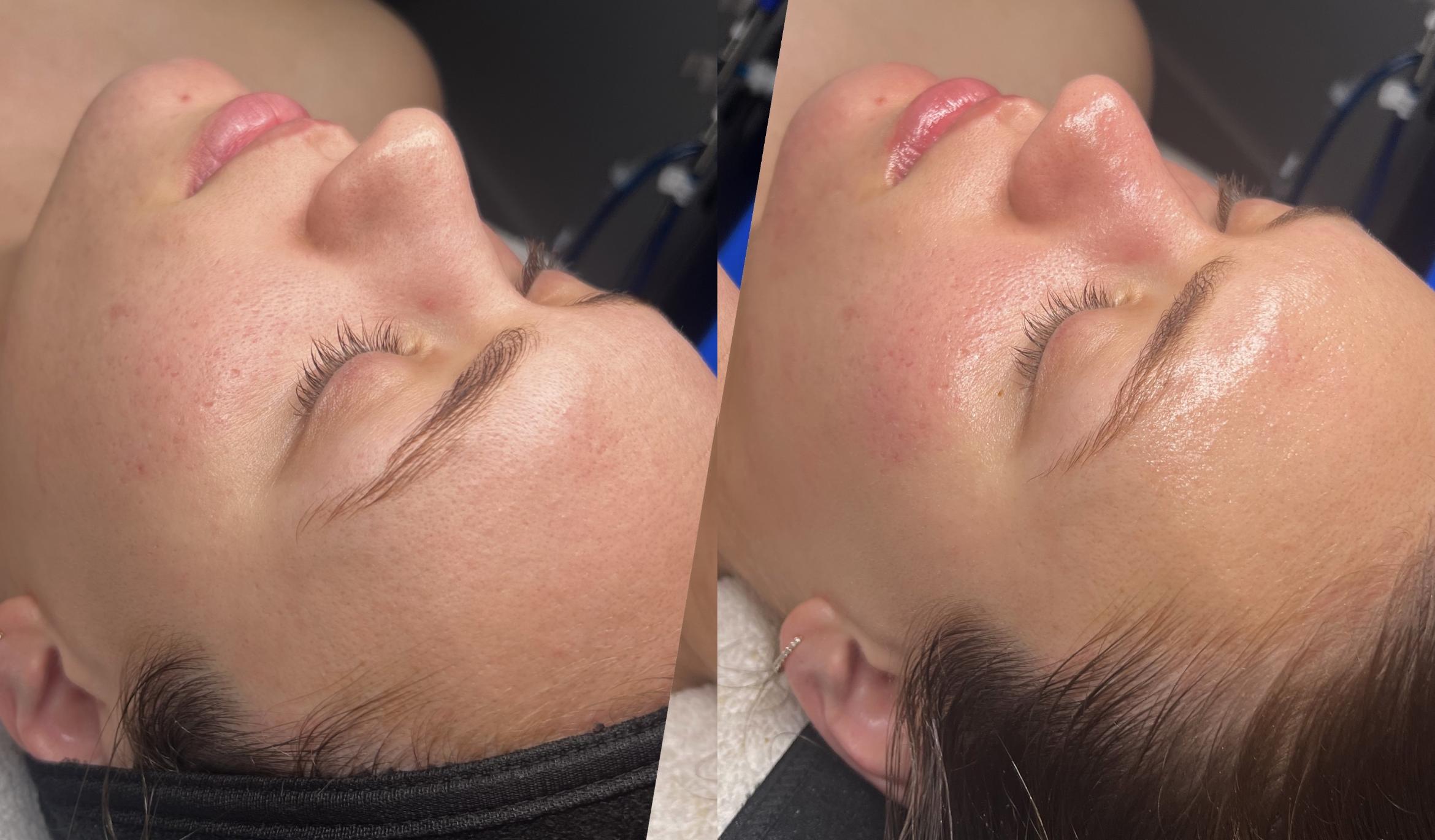 Before & After Hydrafacial™ Client #58 Left Side View in Tampa Bay, North Palm Beach, FL