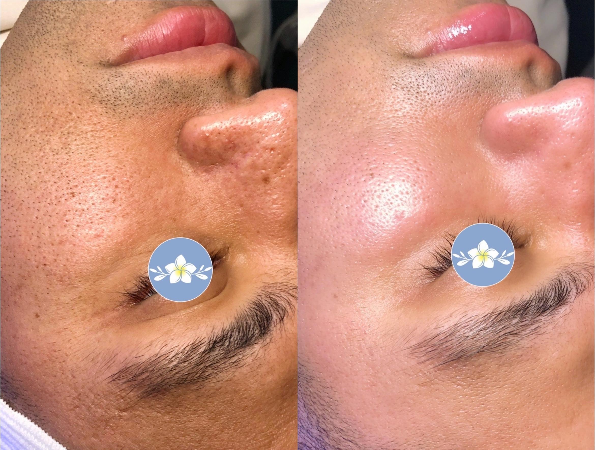 Before & After Hydrafacial™ Client #67 Left Side View in Tampa Bay, North Palm Beach, FL