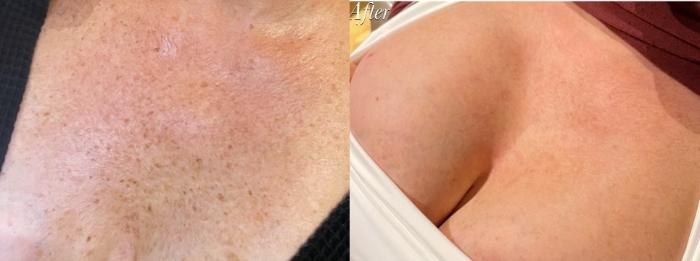 Before & After IPL Photofacial Client #14 Front View in Tampa Bay, North Palm Beach, FL