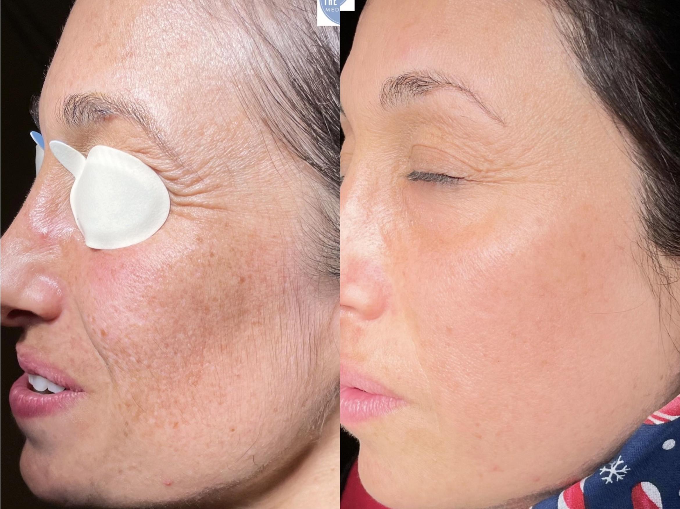 Before & After IPL Photofacial Client #17 Left Side View in Tampa Bay, North Palm Beach, FL