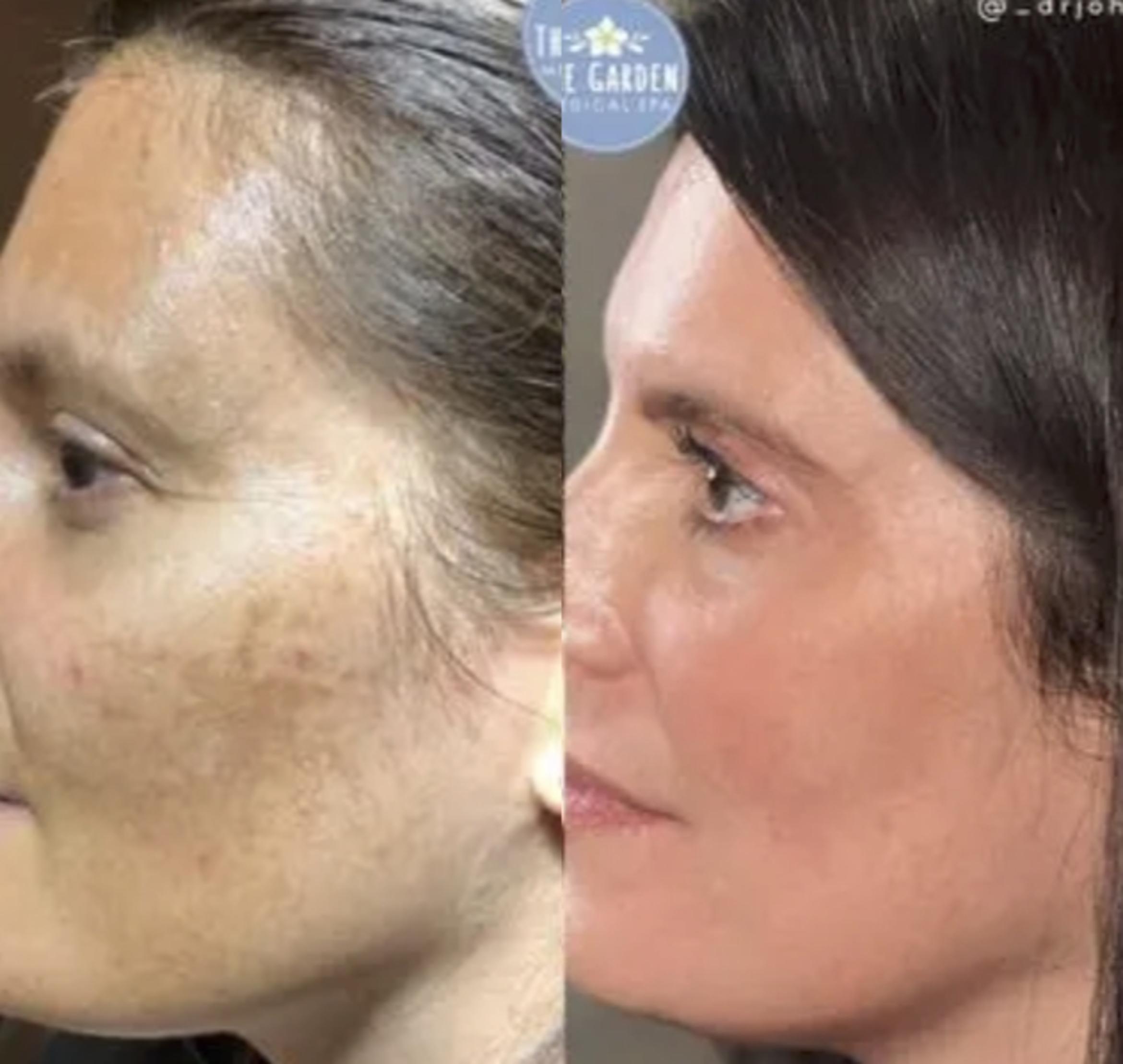 IPL for Hyperpigmentation