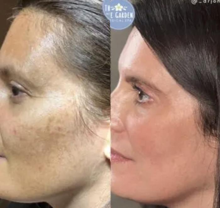 IPL for Hyperpigmentation