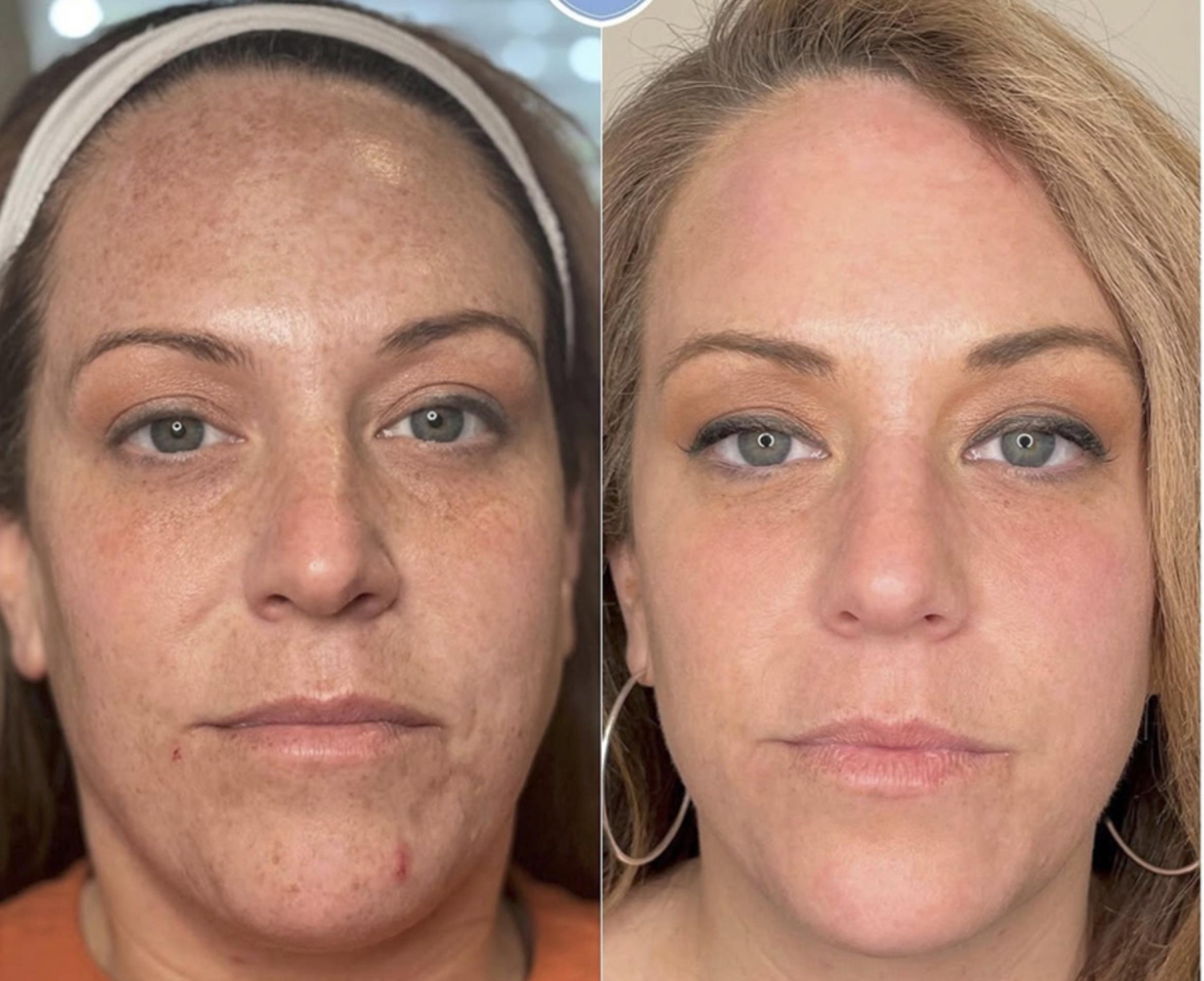IPL for Sun Damage