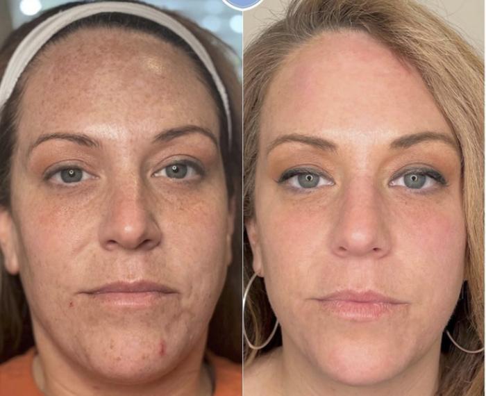 IPL for Sun Damage
