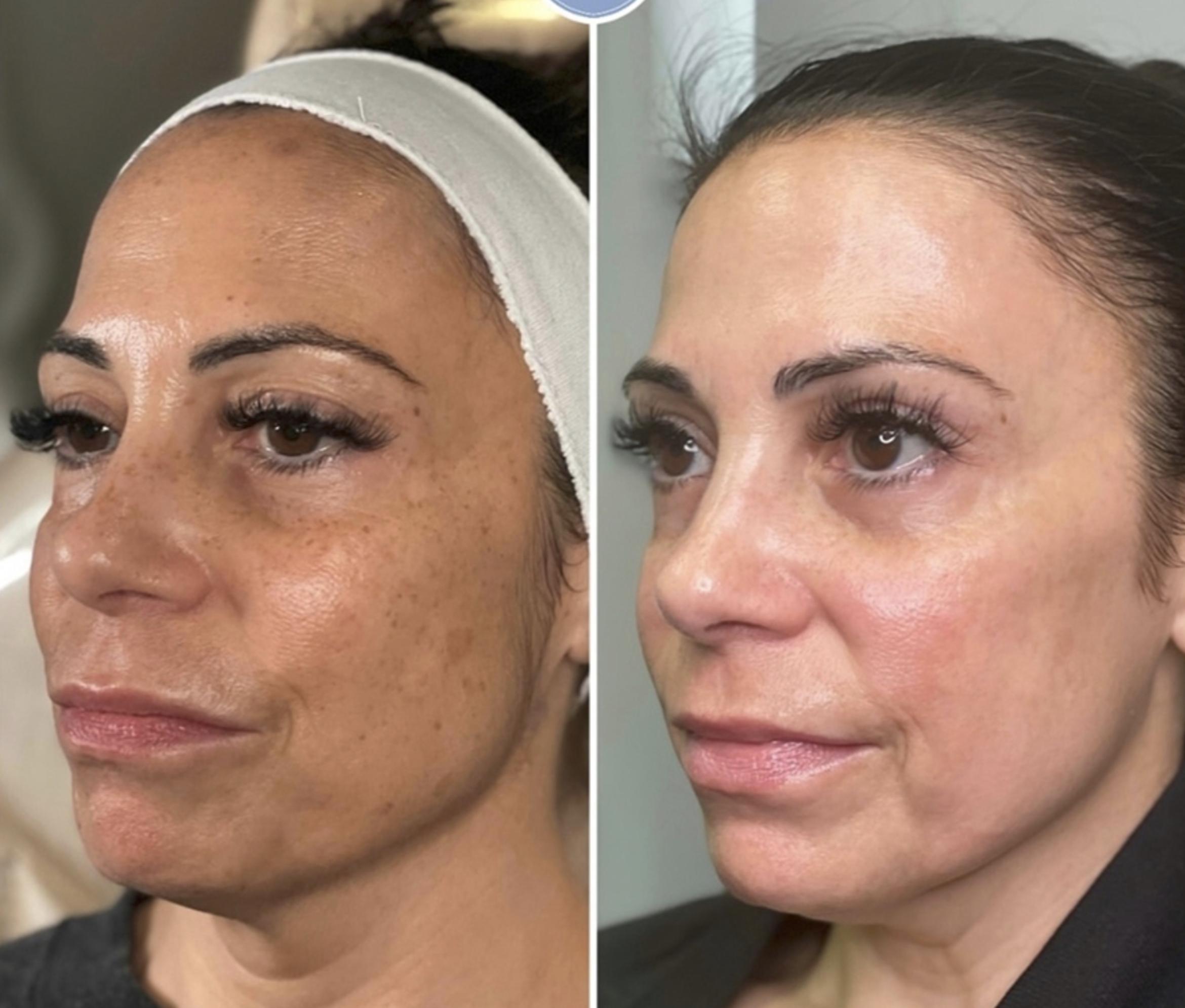 ipl for Even Tone