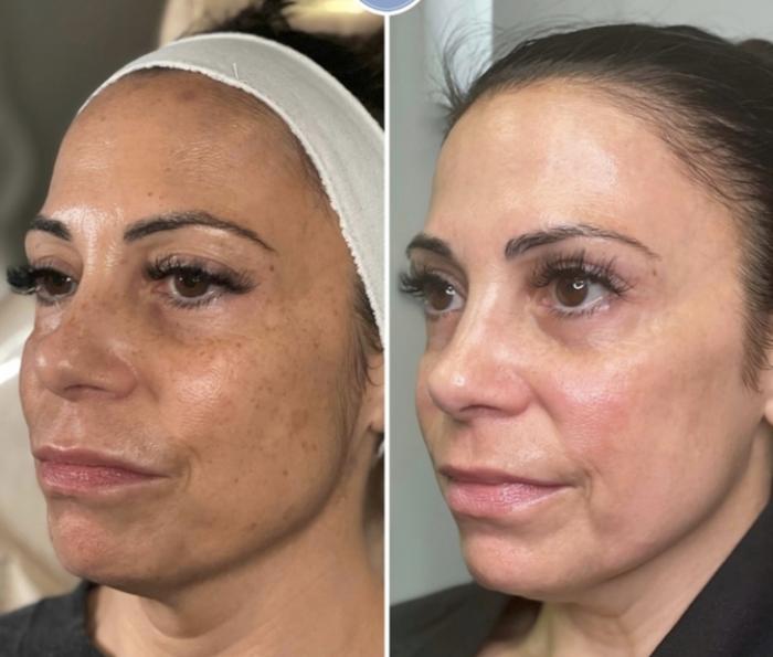 ipl for Even Tone