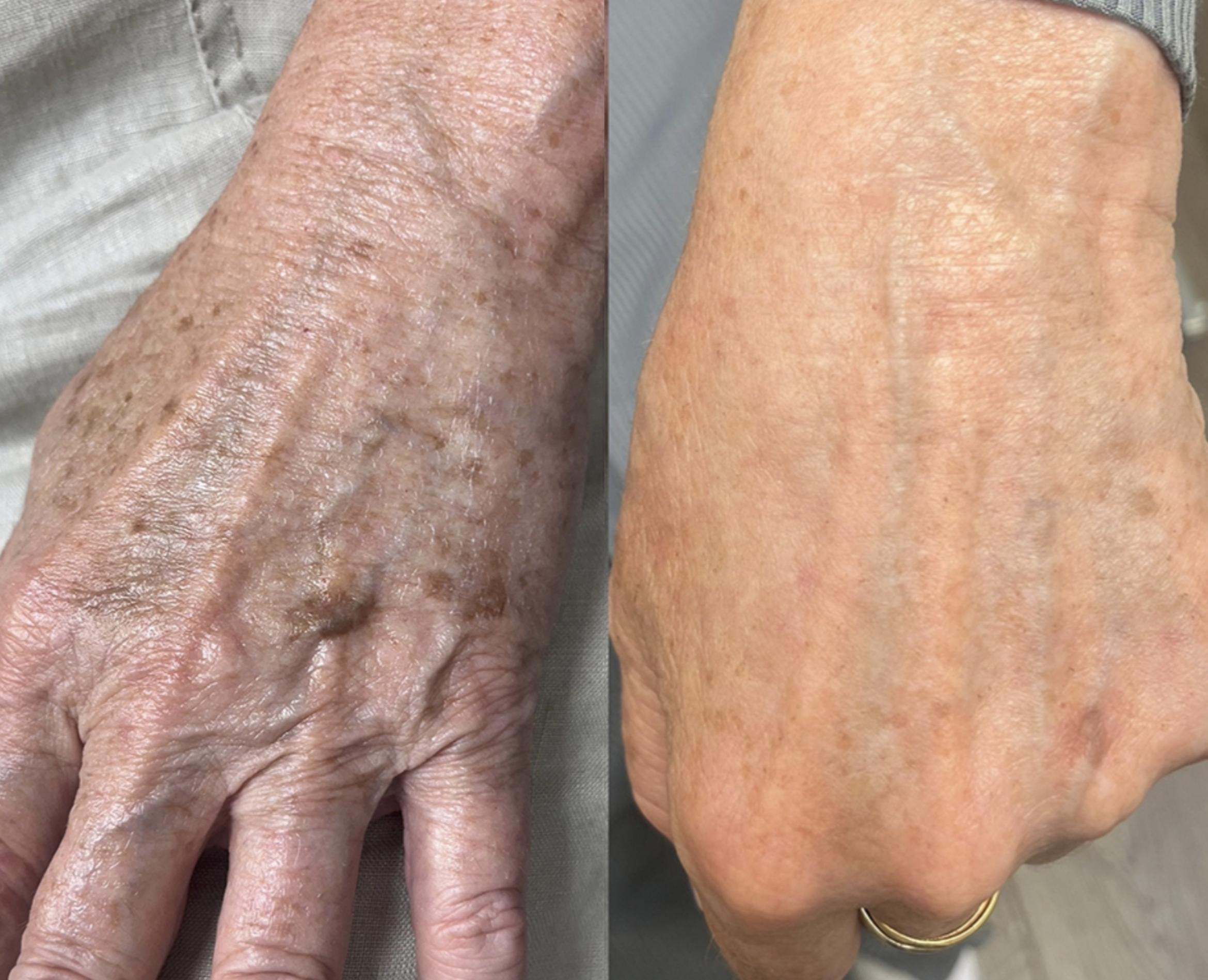 IPL for Hands