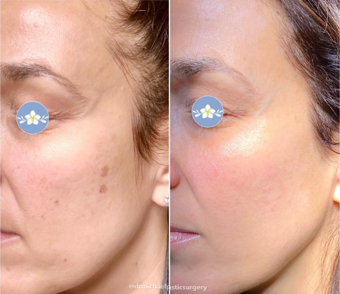 Before & After IPL Photofacial Client #45 Left Side View in Tampa Bay, North Palm Beach, FL