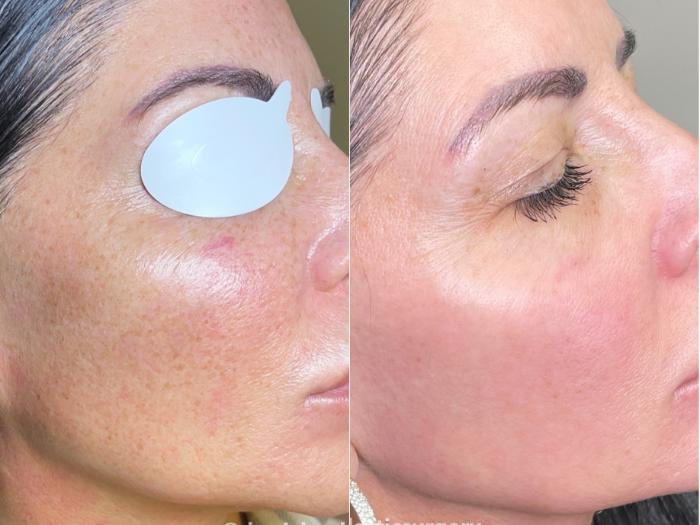 Before & After IPL Photofacial Client #52 Right Side View in Tampa Bay, North Palm Beach, FL