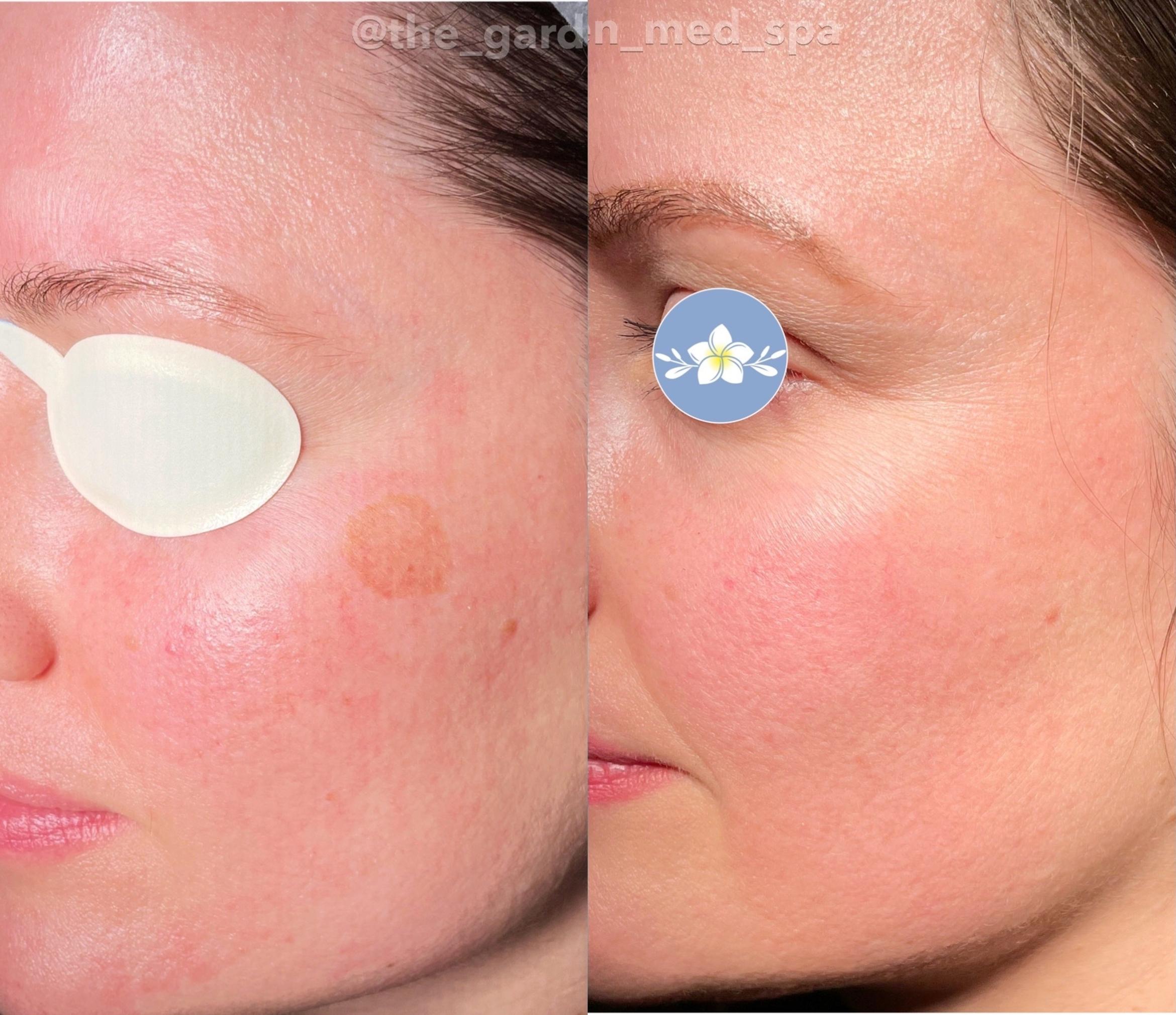 Before & After IPL Photofacial Client #57 Left Side View in Tampa Bay, North Palm Beach, FL