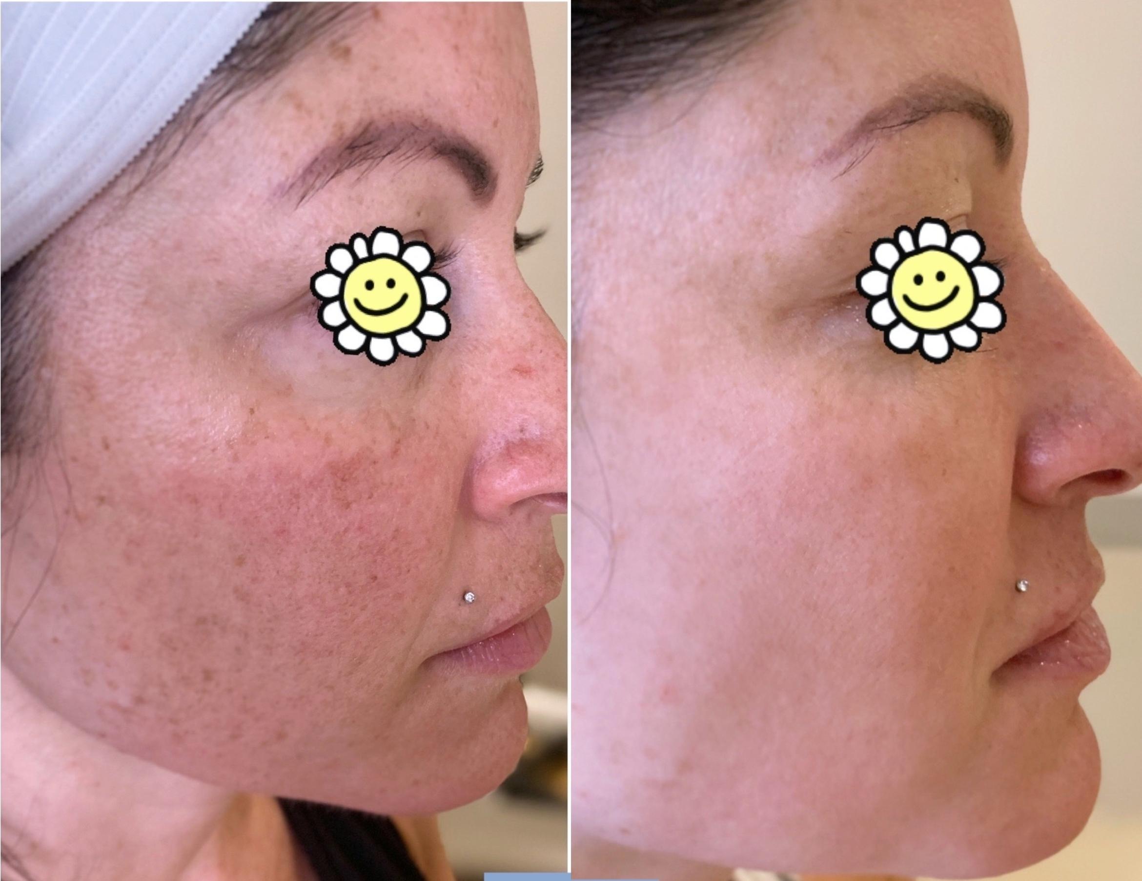 Before & After IPL Photofacial Client #64 Right Side View in Pinellas Park, Clearwater, St. Petersburg, North Palm Beach