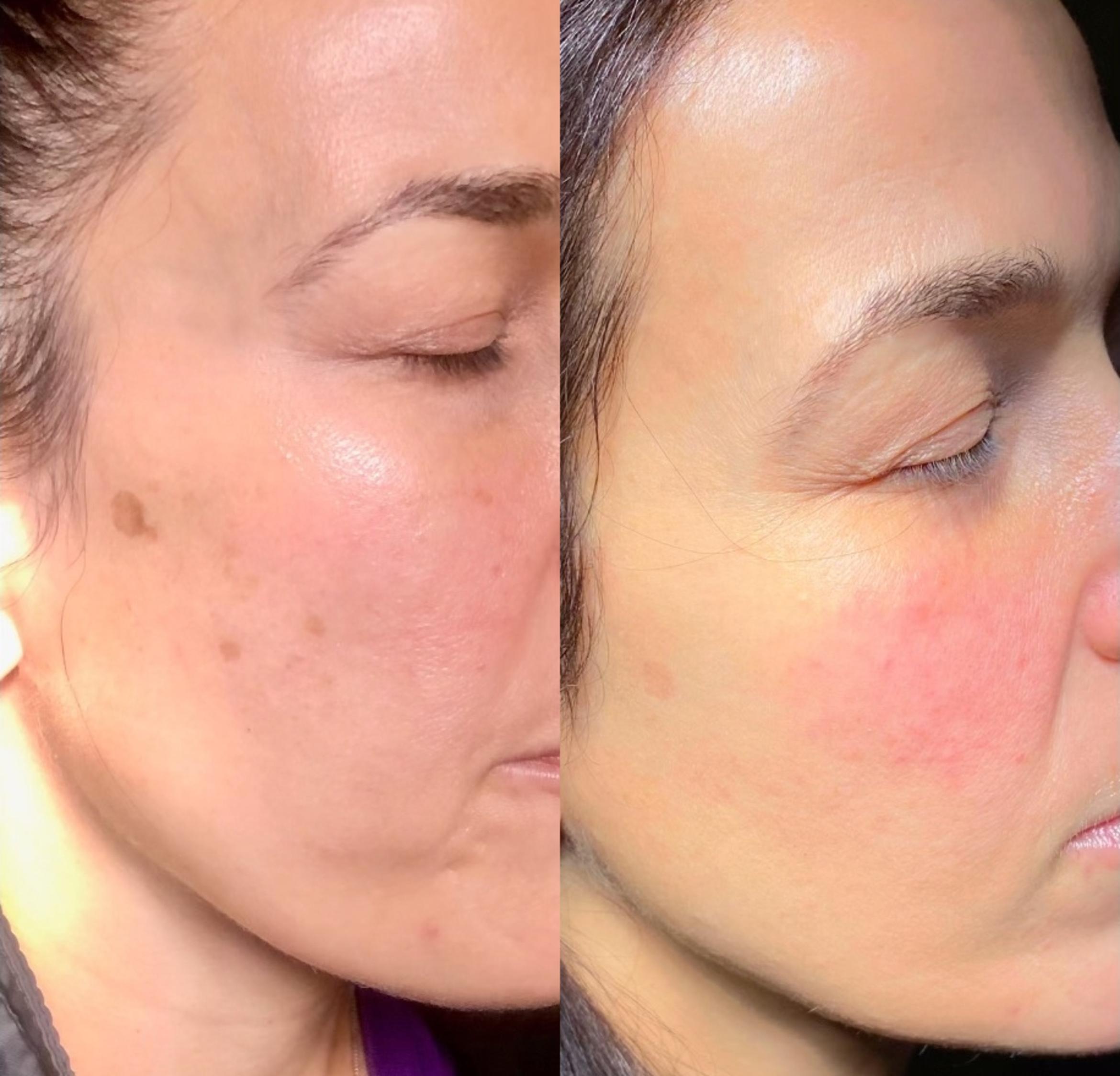 Before & After IPL Photofacial Client #74 Right Side View in Tampa Bay, North Palm Beach, FL