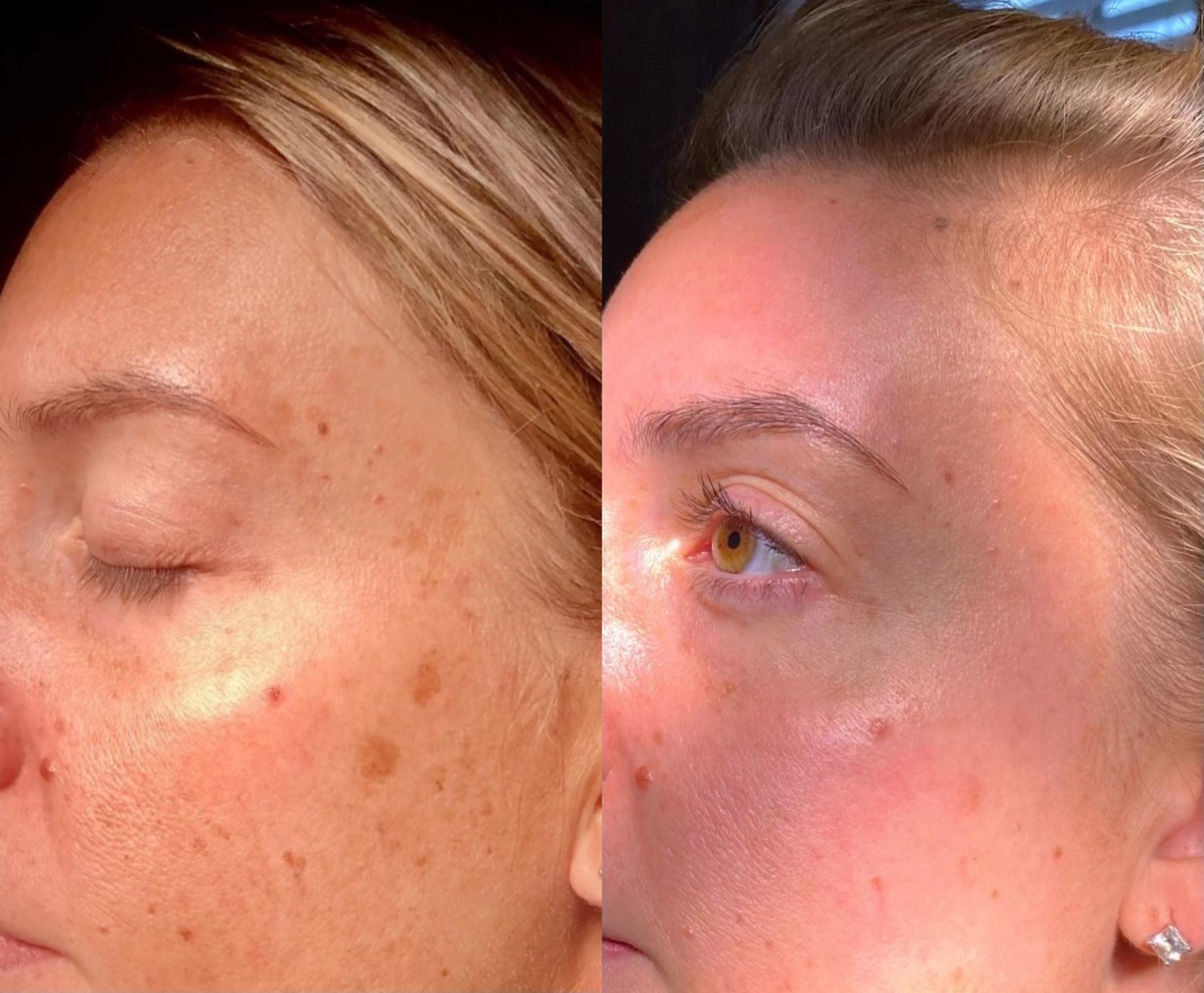 Before & After IPL Photofacial Client #75 Right Side View in Tampa Bay, North Palm Beach, FL