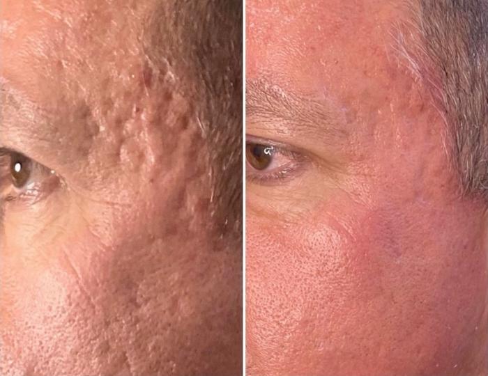 Before & After Laser Skin Rejuvenation Client #32 Left Side View in Tampa Bay, North Palm Beach, FL