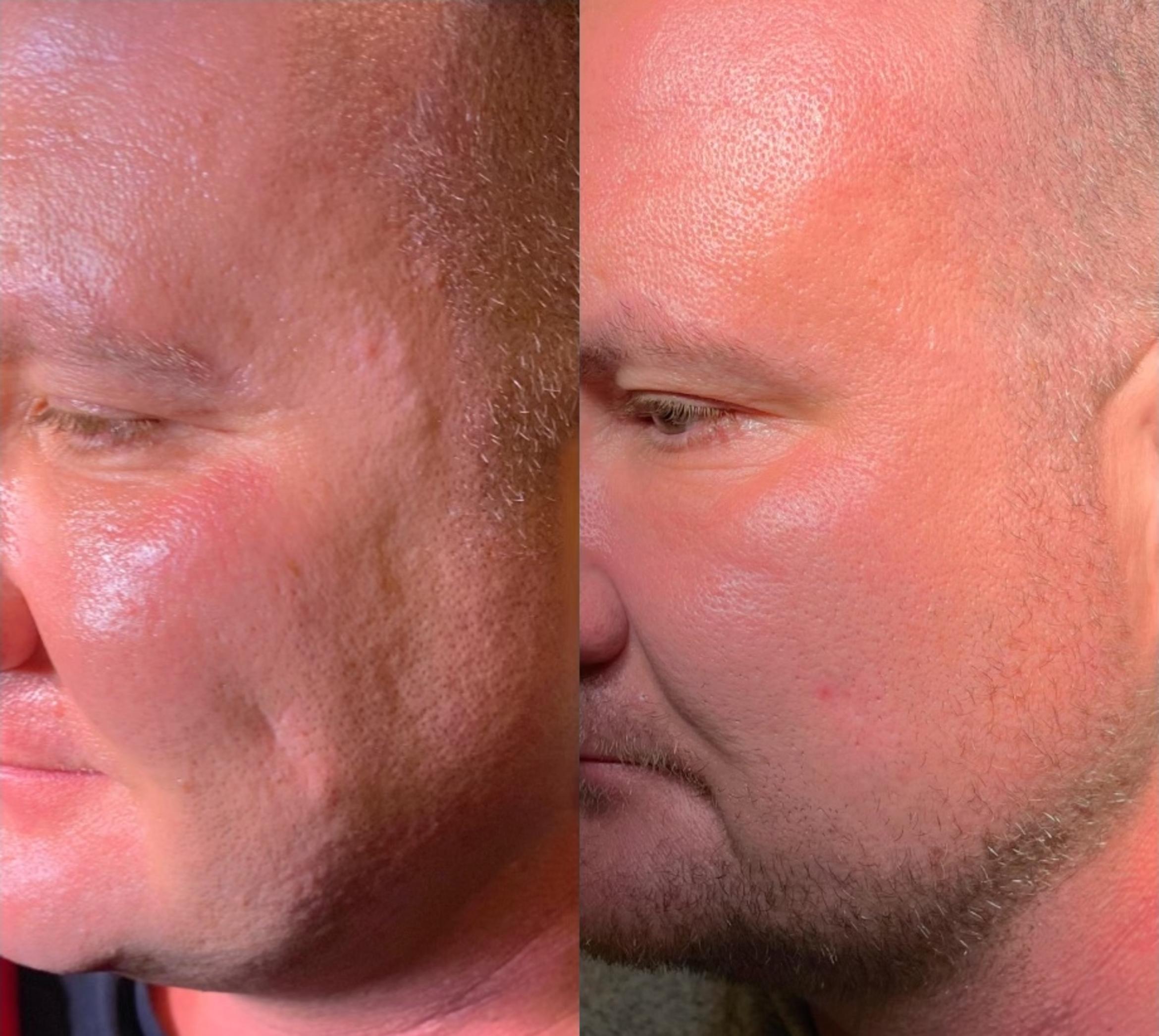 Before & After Laser Skin Rejuvenation Client #76 Left Side View in Tampa Bay, North Palm Beach, FL