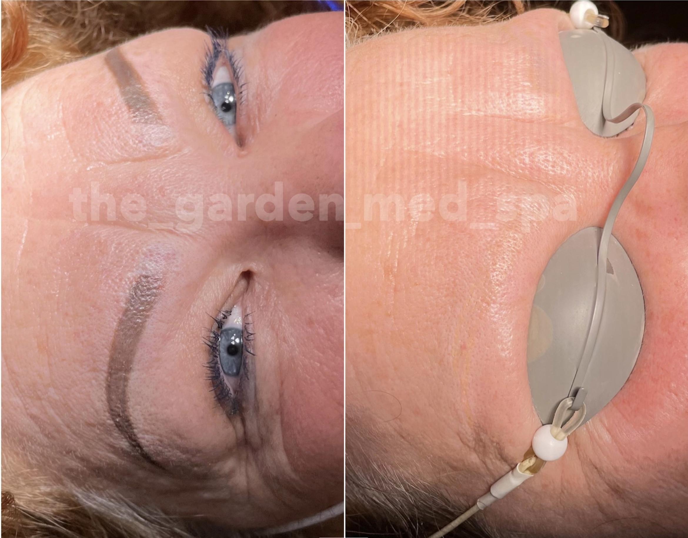 Tattoo Eyebrow Removal