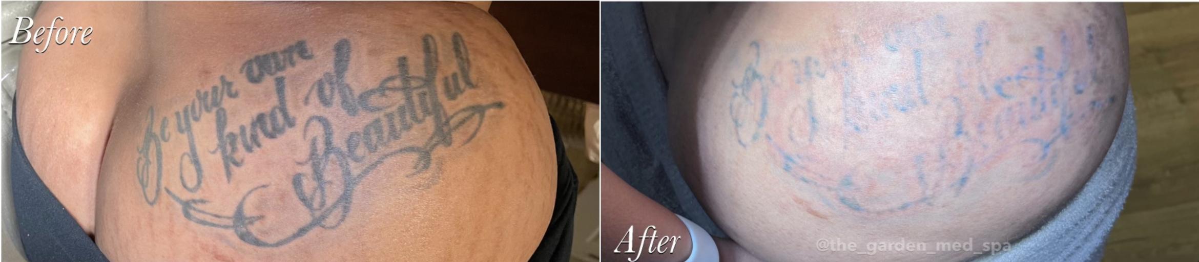 2 Sessions of Laser Tattoo Removal