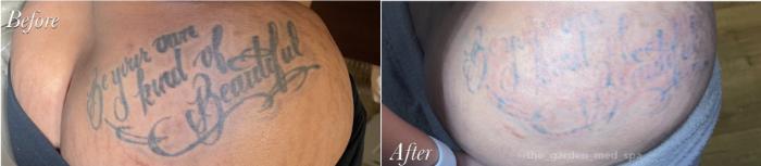 2 Sessions of Laser Tattoo Removal