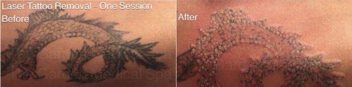 One Session of Laser Tattoo Removal