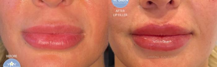Before & After Lip Filler Client #231 Front View in Pinellas Park, Clearwater, St. Petersburg, North Palm Beach
