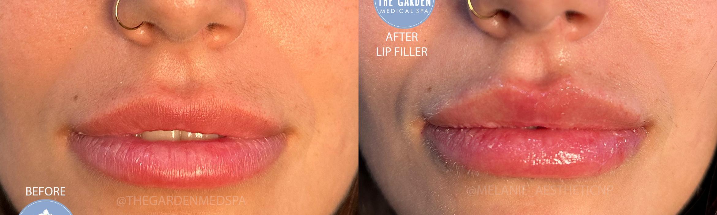 Lip Filler for Volume Enhancement
