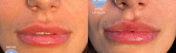 Lip Filler for Volume Enhancement