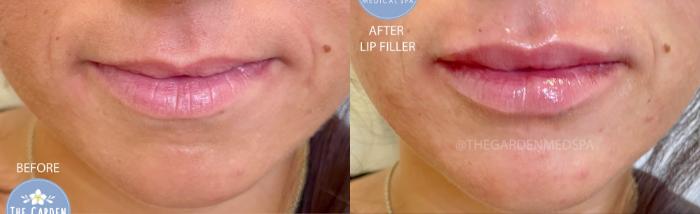 Lip Filler for Balancing