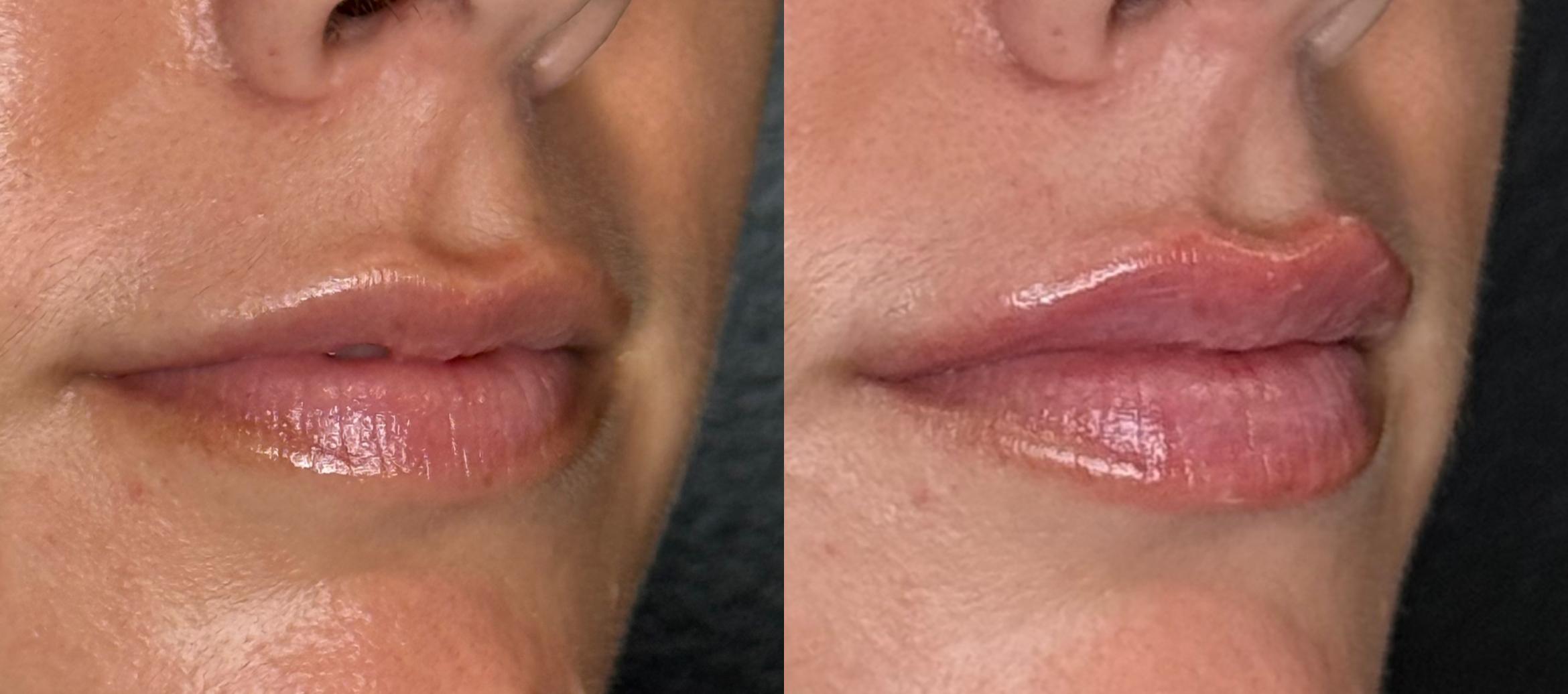 Bridal Lip Filler