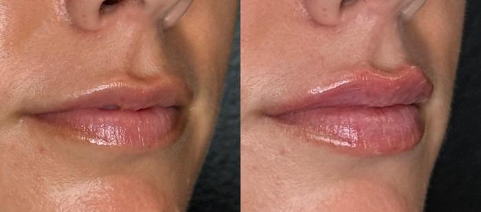 Bridal Lip Filler