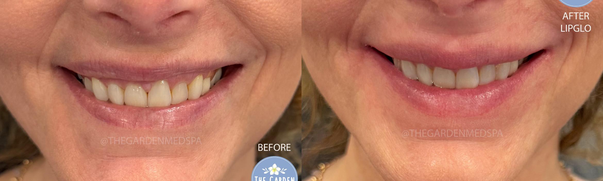 LipGlo for Gummy Smile