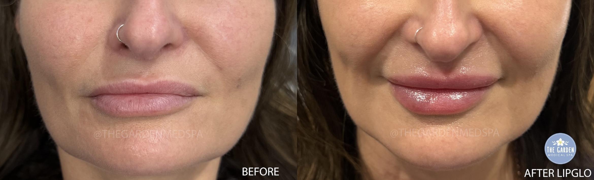 LipGlo for Plumpness