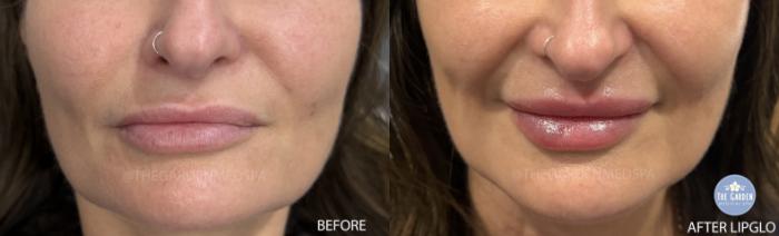 LipGlo for Plumpness