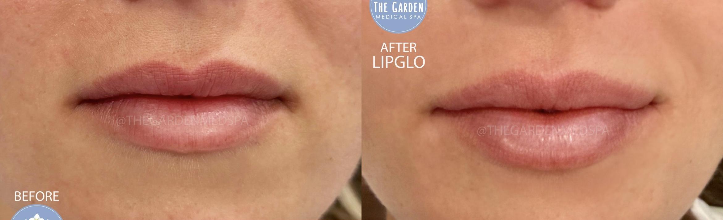 LipGlo with Resurfx