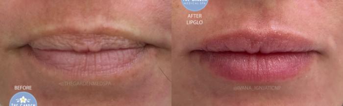 LipGlo for Lip Coloration & Hydration