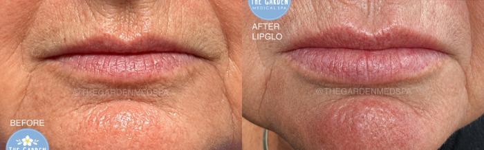 LipGlo for Lip Enhancement