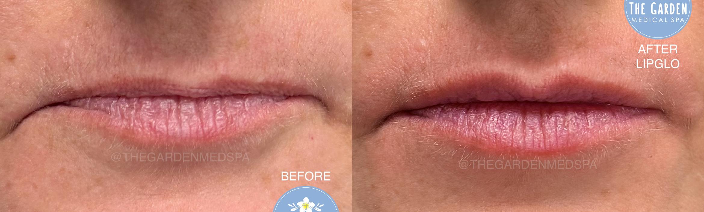 LipGlo Instant Enhancement