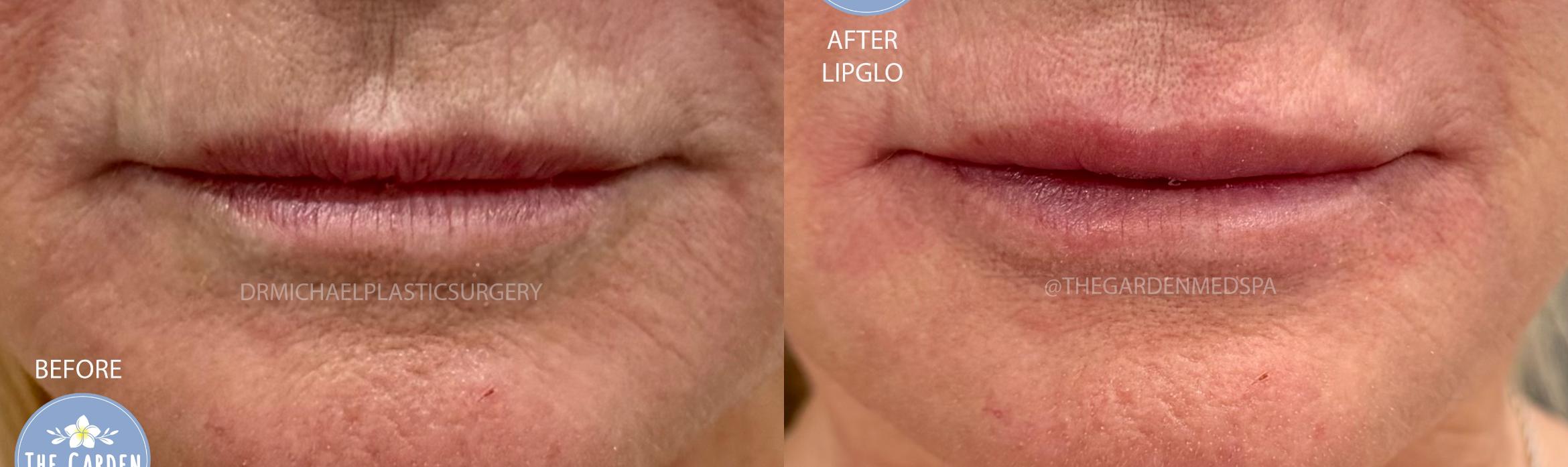 LipGlo for Deep Lip Hydration
