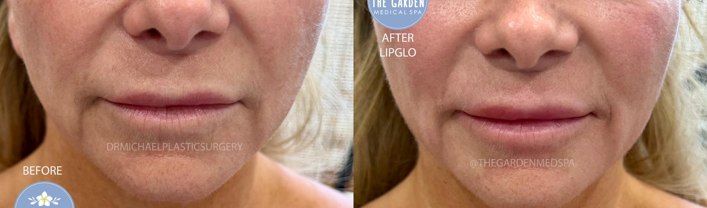 LipGlo on Lip Filler