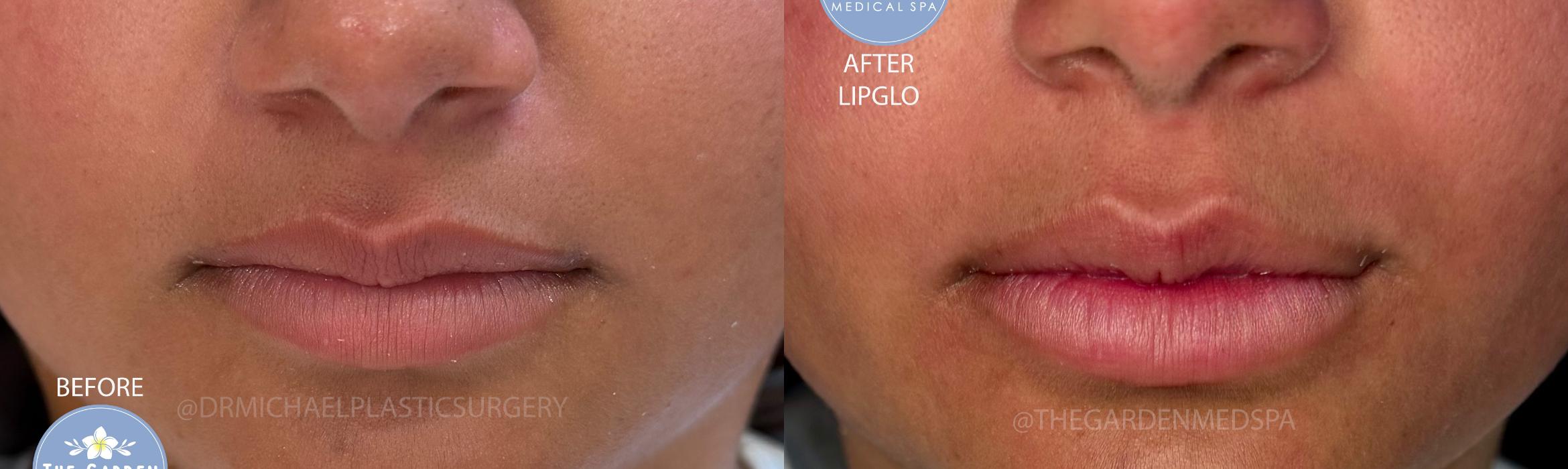 LipGlo for Full Plump