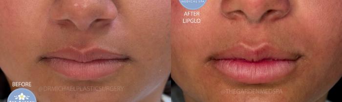 LipGlo for Full Plump