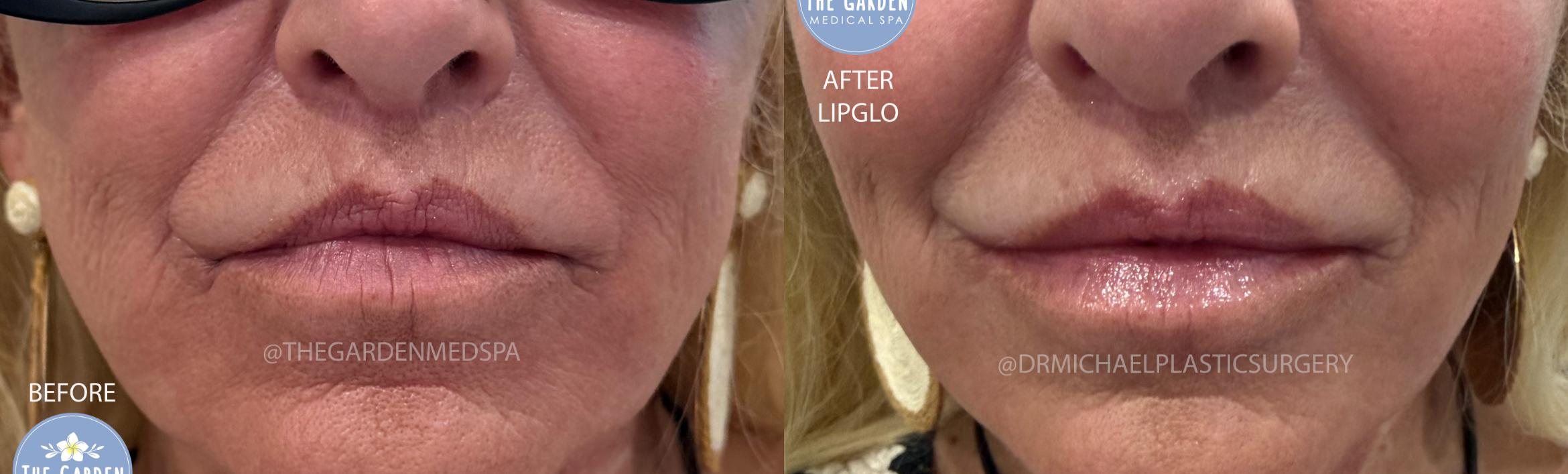 LipGlo