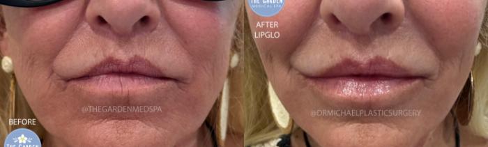 LipGlo