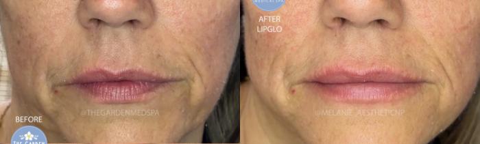 LipGlo for Smoothness & Hydration