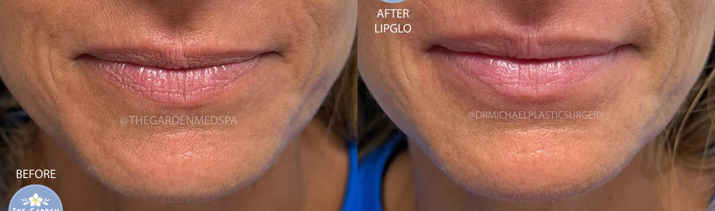LipGlo
