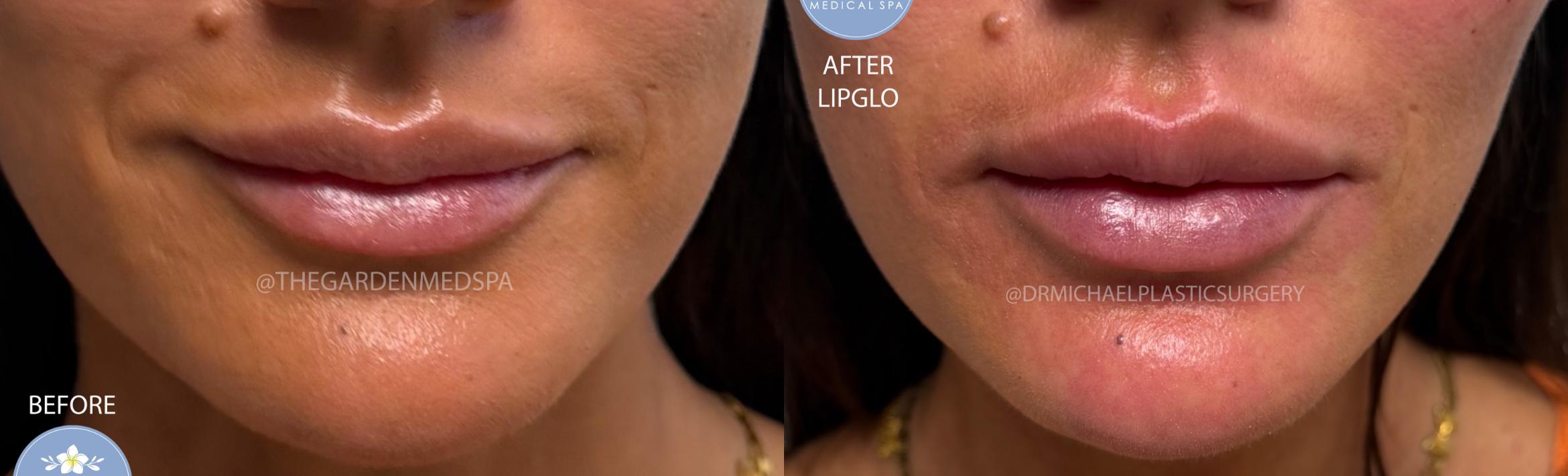 LipGlo on Lip Filler