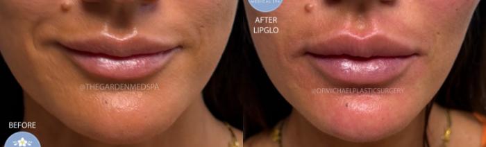 LipGlo on Lip Filler